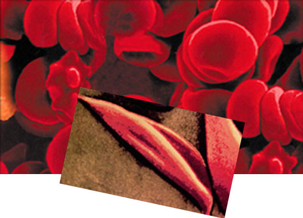 cell_anemia